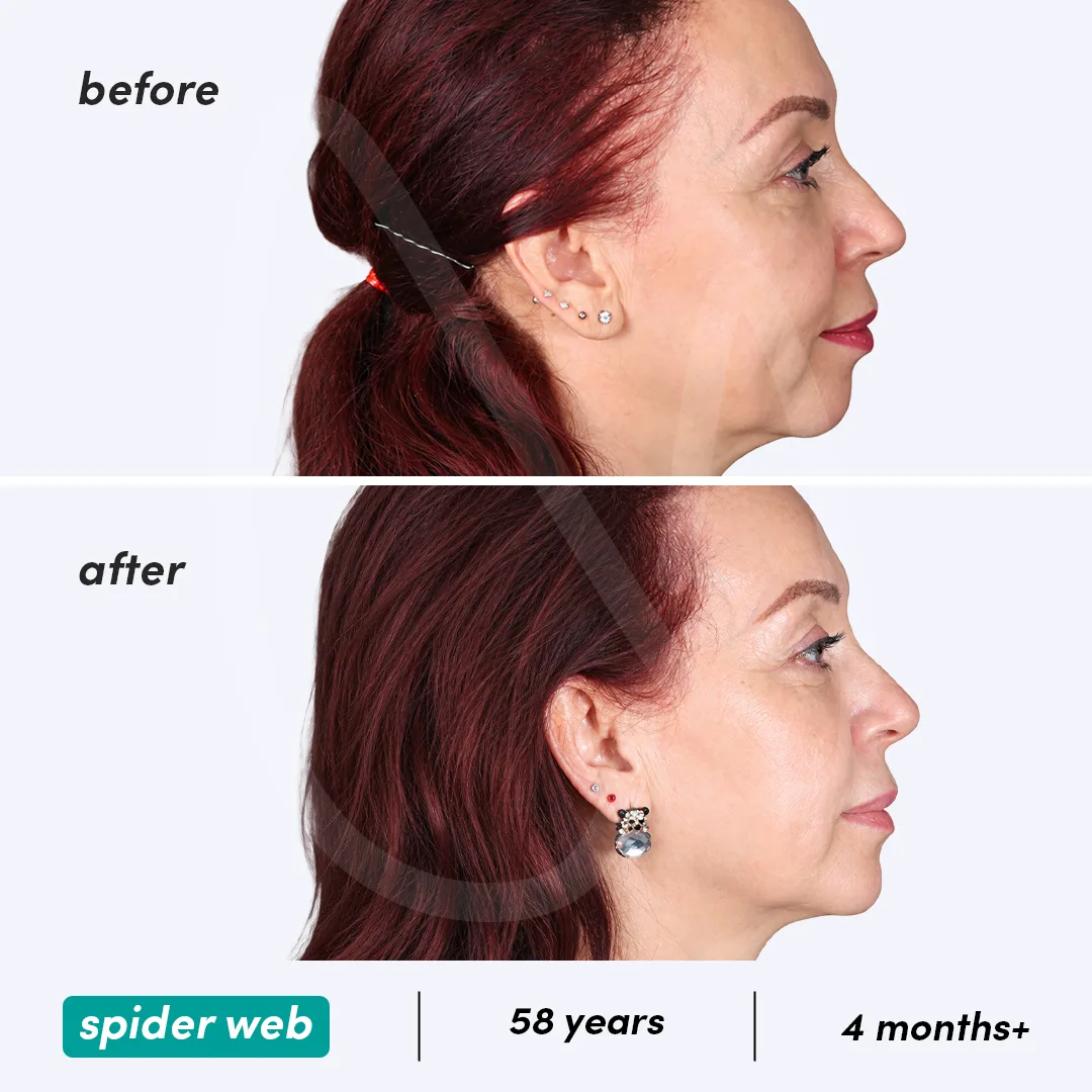 Before-After Combined